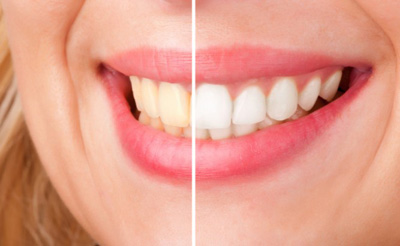 مسواک زدن باعث می شود که پلاک های دندانی از بین بروند 